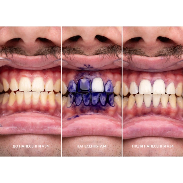 Засіб для відбілювання зубів SmileKit V34 Коректор кольору зубів 30 мл (5.3010) - picture 9