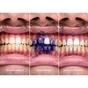 Засіб для відбілювання зубів SmileKit V34 Коректор кольору зубів 30 мл (5.3010) - уменьшенное изображение 9