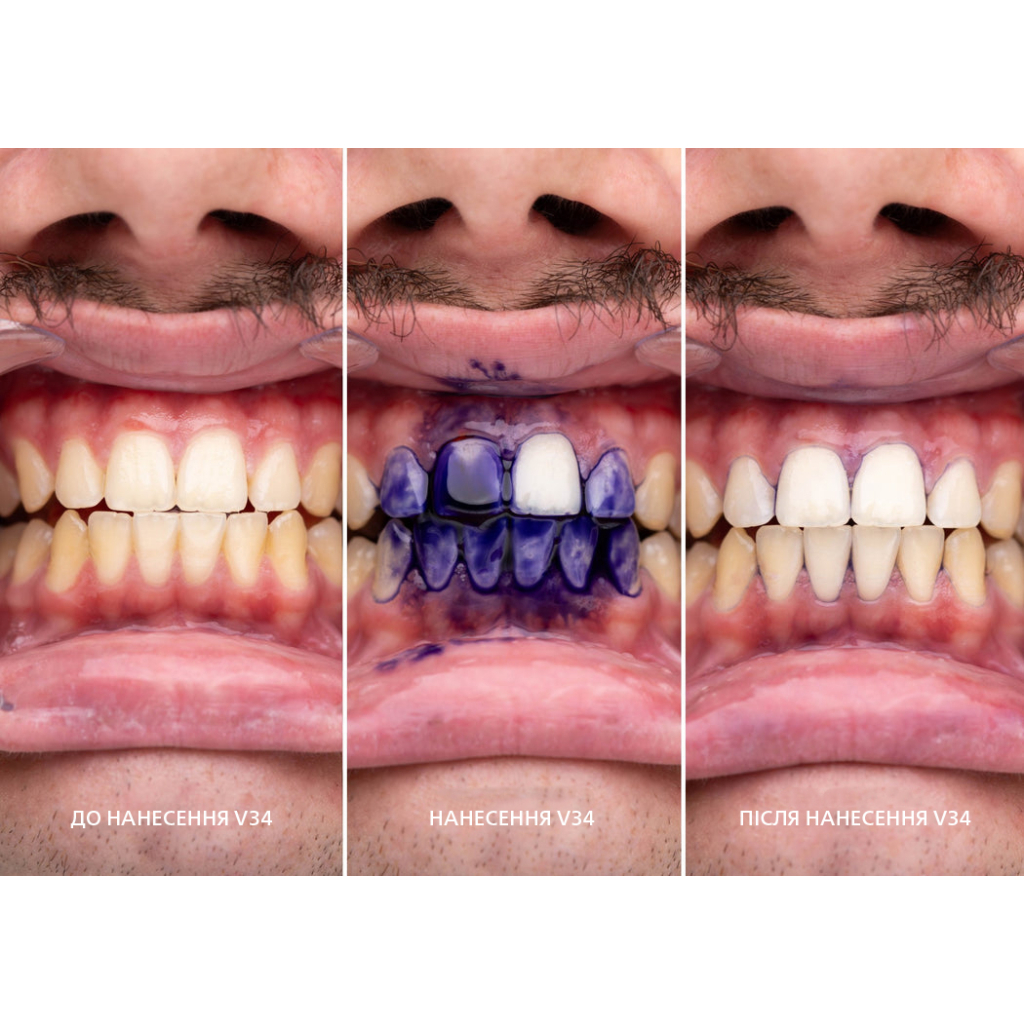 Засіб для відбілювання зубів SmileKit V34 Коректор кольору зубів 30 мл (5.3010) - изображение 9